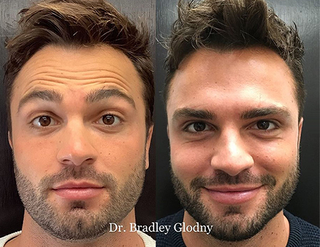 before and after botox dysport front view male patient Park Avenue Dermatology New York