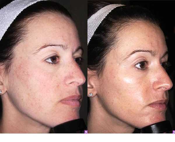 before and after cosmetic treatment right angle view female patient New York