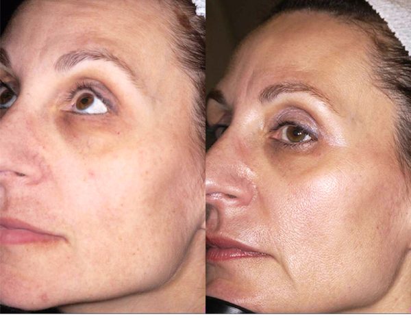 before and after cosmetic treatment left angle view female patient New York