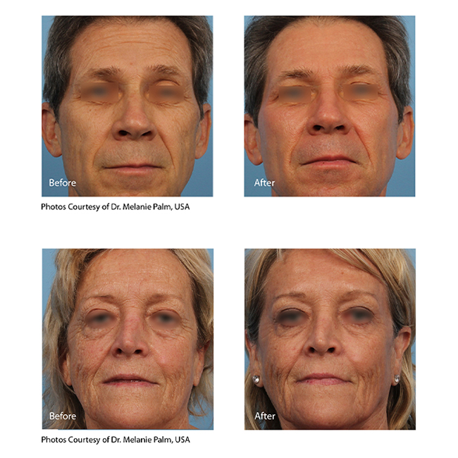 before and after eCO2 Laser front view male and female patients NYC