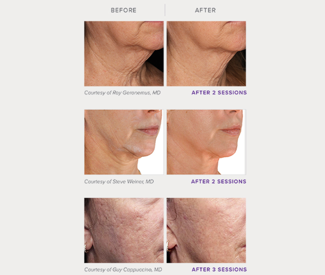 before and after Genius RF Microneedling right angle view female patient NYC