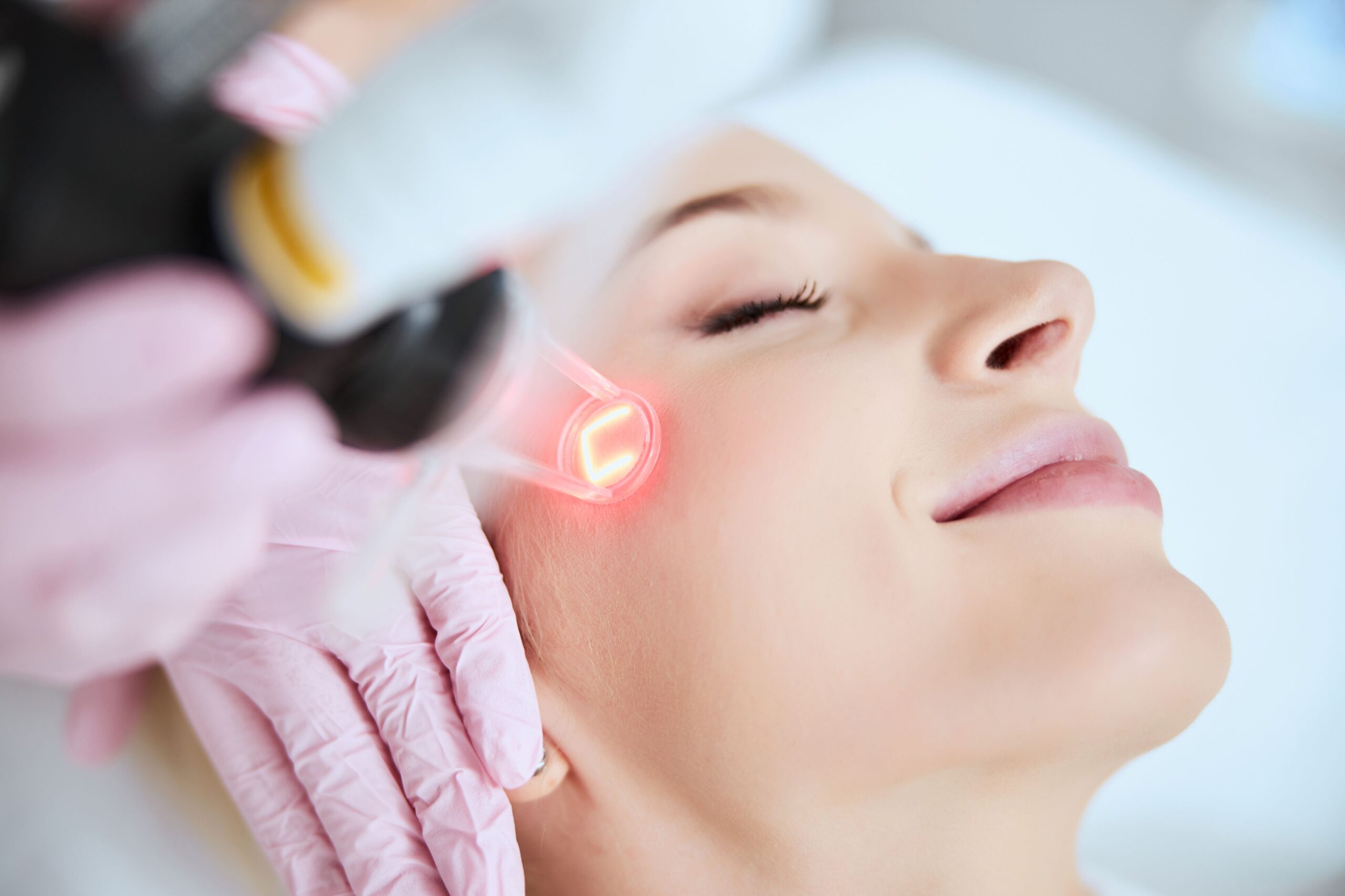 Can Laser Treatments Reduce Acne Breakouts Long-Term?